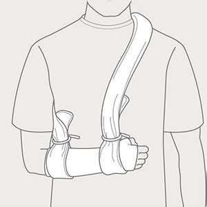 Keep the collar and cuff sling away from children to prevent choking hazards, unless it is necessary for an arm injury. Collar'n'Cuff | Mölnlycke