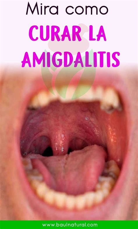 Remedios Caseros Para La Amigdalitis