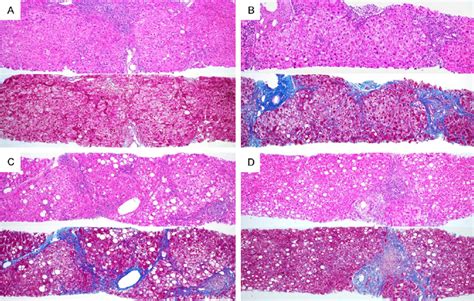 Histological Findings Of Liver Biopsies Of The Four Cases A Case 1