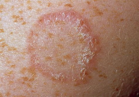 Ringworm On Arm Photograph By