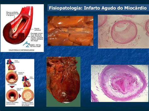 O enfarte do miocárdio, é a principal causa de morte em portugal, com números preocupantes que rondam as 4000 mortes por ano, segundo a direção geral de saúde. Infarto agudo do miocárdio