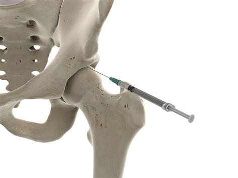 Intra Articular Hip Injection Excel Pain And Spine