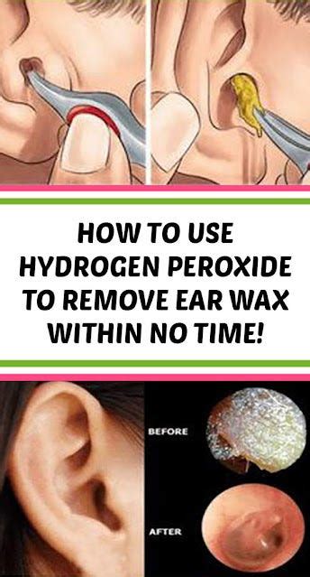 How To Use Hydrogen Peroxide To Remove Ear Wax Within No Time