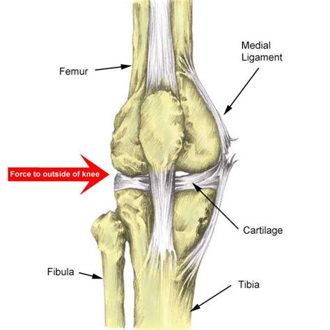 Medial Knee Ligament MCL Sprain Symptoms Treatment Exercises