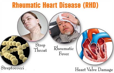 Rheumatic Heart Disease Causes Symptoms Treatment