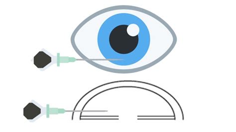 Anterior Chamber Paracentesis In Uveitis Eyewiki