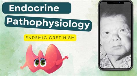Cretinism An Iodine Deficiency Disorder My Endo Consult