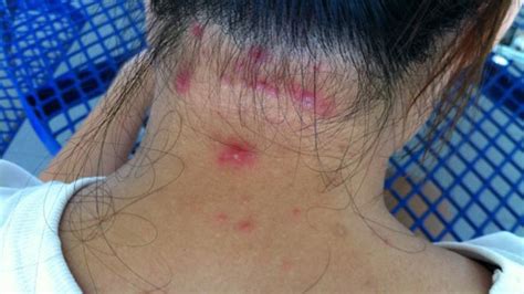 However, skin rashes can be caused. Early Warning Signs of HIV & AIDS that Most People Miss - Your Everyday Health Blog