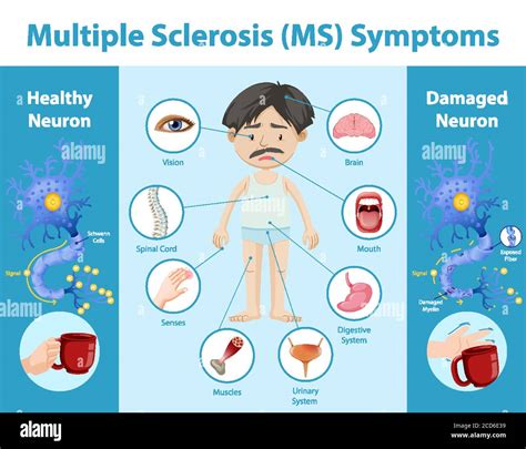 Multiple Sclerosis Ms Symptoms Information Infographic Illustration