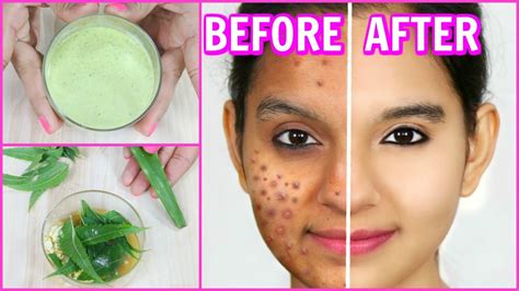 Remove Pimples Permanently 100 Results Diy Face Wash Spot