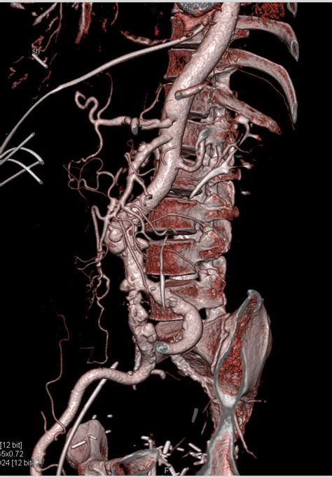 Celiac Artery Dissection In Patient With Vasculitis Vascular Case