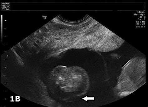 Amniotic Band Syndrome In Dichorionic Diamniotic Twin Pregnancy