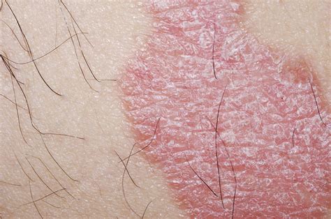 Psoriasis On A Mans Body Stock Image M2400604 Science Photo Library