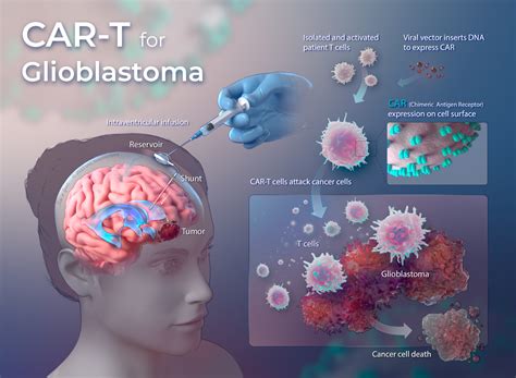 New Treatments For Glioblastoma 2024 - Darda Elspeth
