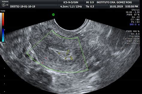 Gynecological Ultrasound Dra Gómez Roig Institute