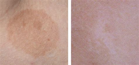 Examples Of A Hyperpigmented And B Hypopigmented Skin Lesions Found