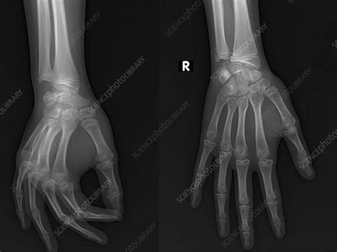 Healthy Hand X Ray Stock Image F0394342 Science Photo Library