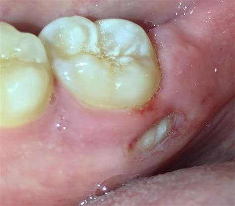 Bone Fragment Coming Out Of My Gums After Wisdom Teeth Extraction Any