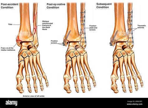 Fracture Fibular Plates Hi Res Stock Photography And Images Alamy