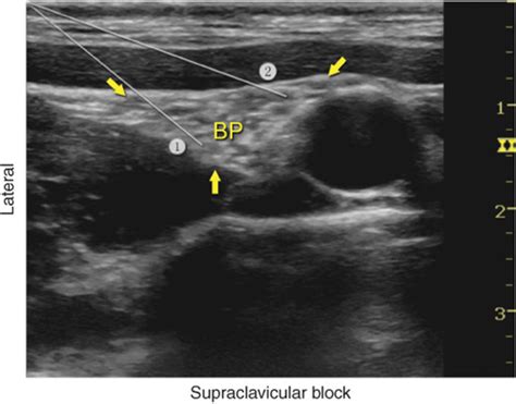 Ultrasound Guided Supraclavicular Brachial Plexus Block Hadzics
