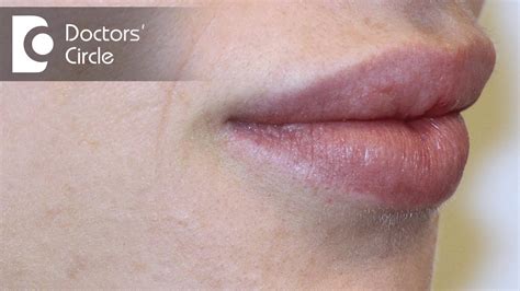 Causes Of White Spots On Lips Dr Nischal K Youtube