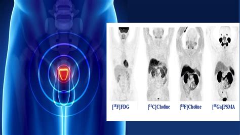 New Crp Use Of Petct With Gallium 68 Labelled Prostate Specific