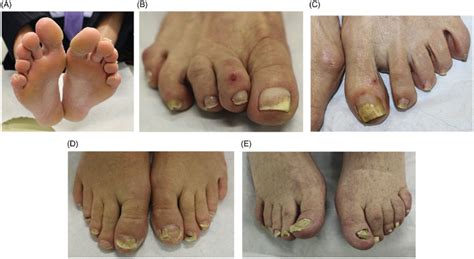 Clinical Examination Findings In Onychomycosis A Tinea Pedis Scale