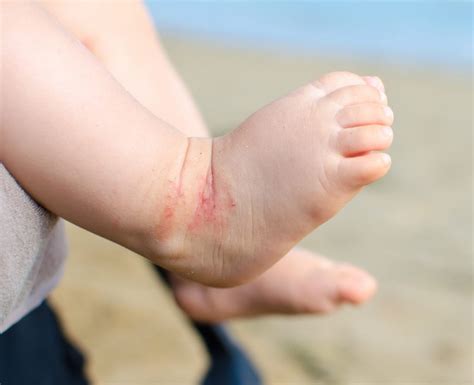 Atopic Dermatitis Newborn Feet Eczema Modern Alternative Mama