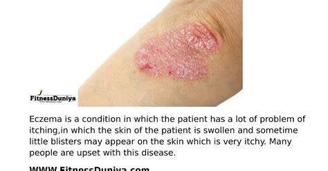 Eczema Symptoms Causes And Treatment