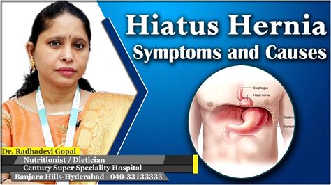 Hernia Symptoms And Causes Hiatus Hernia Diet Hiatus Hernia