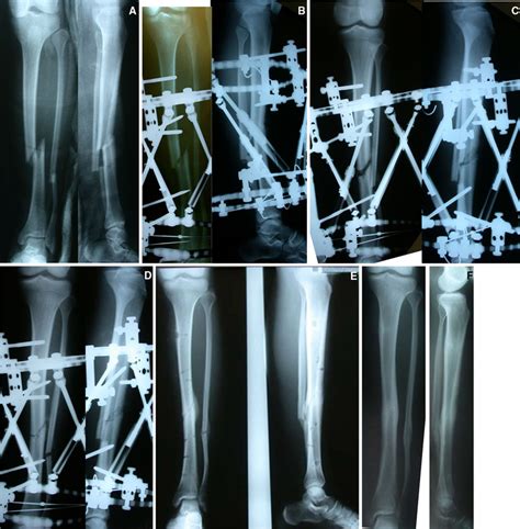 A 16 Year Old Male Patient With An 8 Week Old Neglected Tibial Shaft