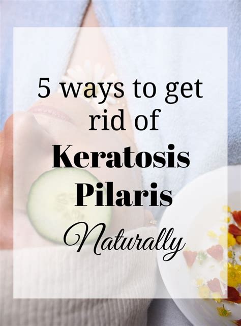 5 Ways To Get Rid Of Keratosis Pilaris Naturally That Will Leave Your