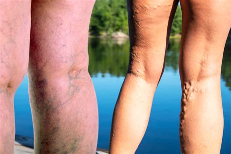Is Restless Leg Syndrome Rls A Symptom Of Varicose Veins