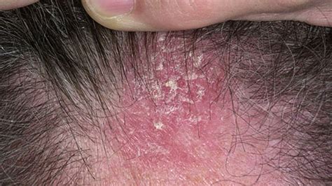 Seborrheic Dermatitis Treatment Diet Causes Symptoms And Pictures