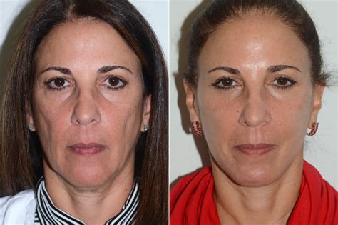 Facelift Before And After Photos Dr Andres Bustillo