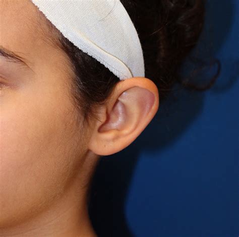 Troy Ear Surgery Before And After Photos Michigan Plastic Surgery