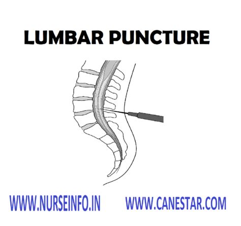 Lumbar Puncture Nurse Info