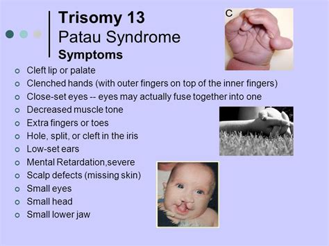 Pin By Nonas Arc On Trisomy 13 Aka Patau Syndrome Patau Syndrome