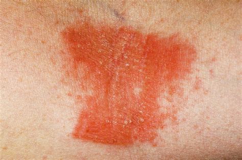 Allergic Rash Photograph By Dr P Marazzi Science Photo Library