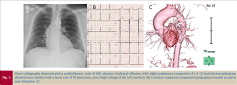 Figure 1 From A Case Of Severe Aortic Stenosis Caused By Unicuspid