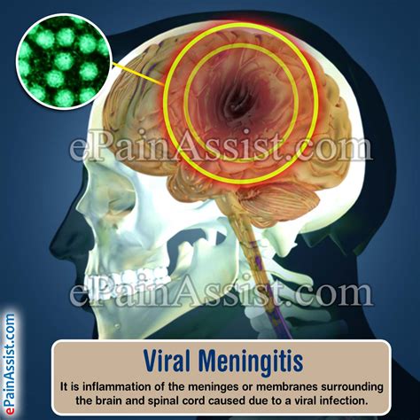 Viral Meningitis: Treatment, Prevention, Symptoms, Causes ...
