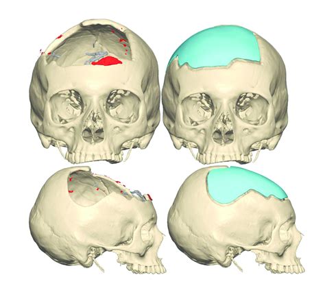 Microsurgical Scalp Reconstruction And Cranioplasty Refined Published