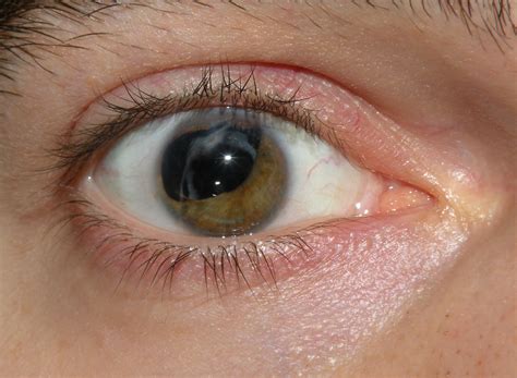 As the cataract grows larger, it clouds more of your lens and distorts the light passing through the lens. Natural cure for cataracts | General center | SteadyHealth.com