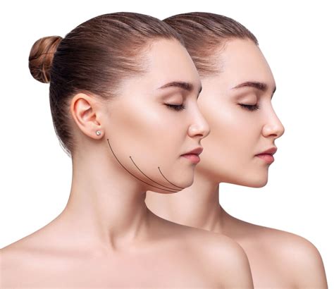 What Are My Options For Non Surgical Facial Slimming And Contouring