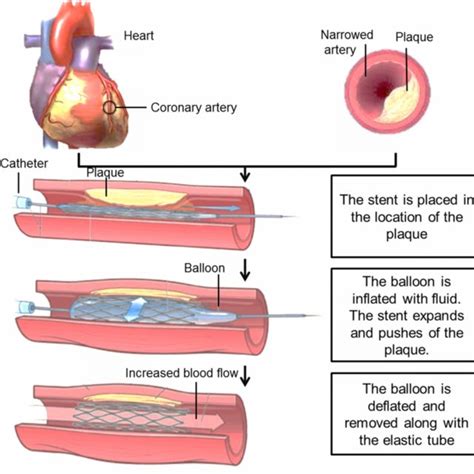 angioplasty with stent implantation procedure schematic illustration download scientific