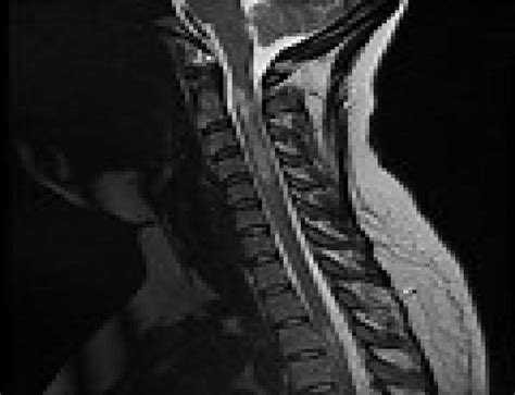 Mri Scan Of Cervical Spine Of A Patient With Multiple Sclerosis Showing