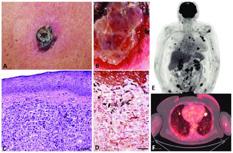 This Figure Presents The Extensive Capability Of Melanoma To Form