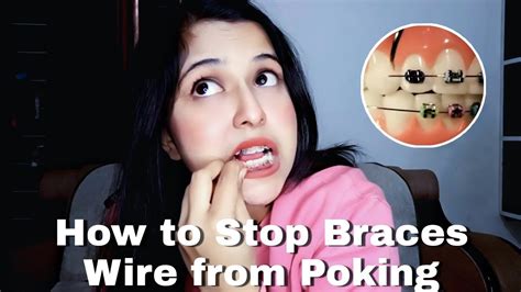 How To Stop Braces Wire From Poking Braces Pain Relief Manya