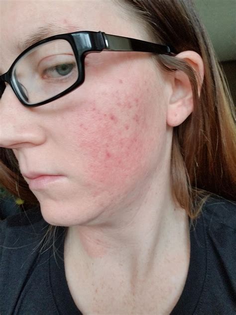 Product Question My Face Seems Irritated Help Story Below R