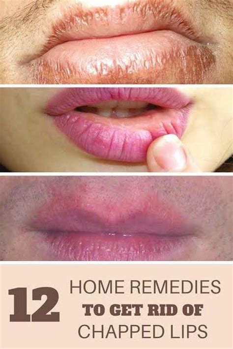 Sign In Home Remedies Lips Chapped Lips